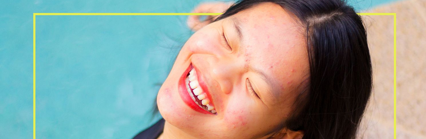 _Acne Positivity Movement _ Embrace Your Imperfections _